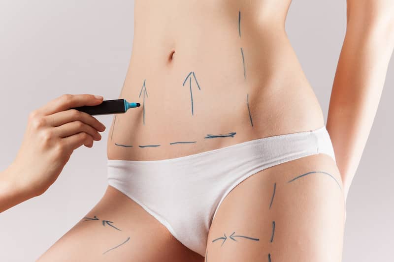 Lipoabdominoplastia