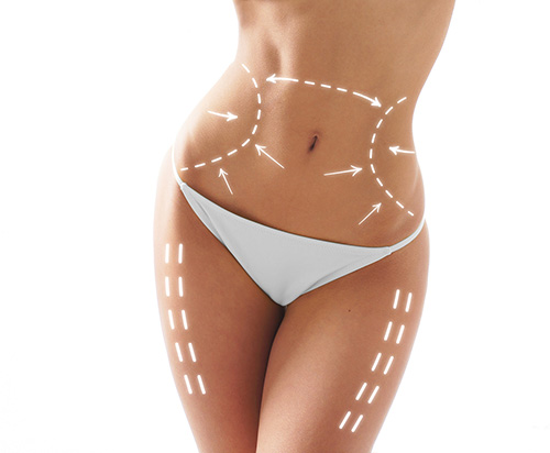 Lipoaspiración